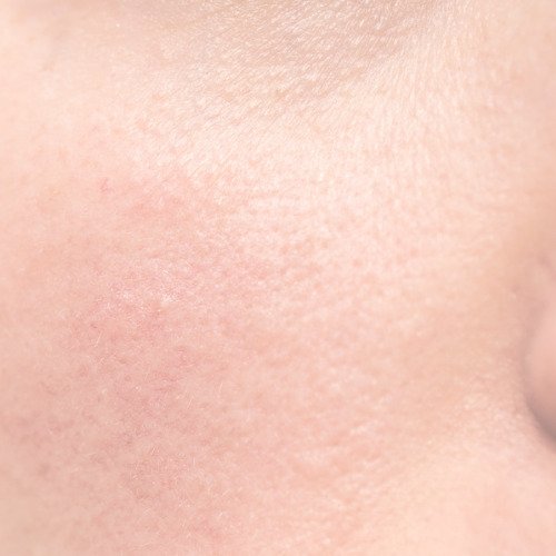 Rosacea